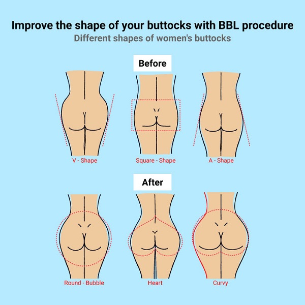 Explaining the 4 most common butt shapes that we see #BBL #BBLdoctor #