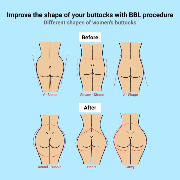 BBL Technique: It's All About the Shape 